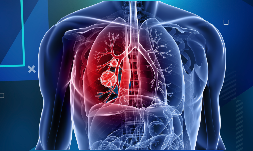 hipertensiune arteriala