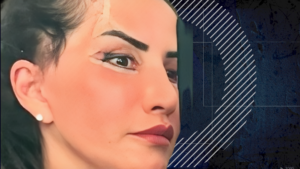 Mara Banica blefaroplastie